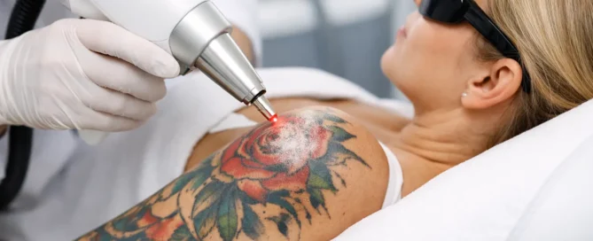 Is Laser Removal Safe for Coloured Tattoos?