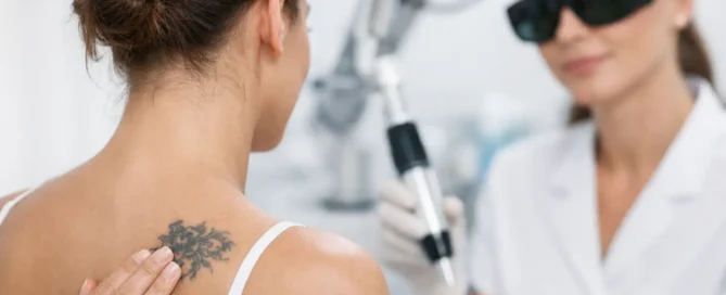 How to Prepare for Tattoo Removal Treatment